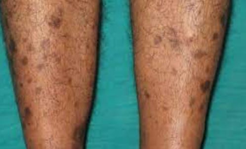 Dark Spots On Legs - Derma kare Skin & Body Centre